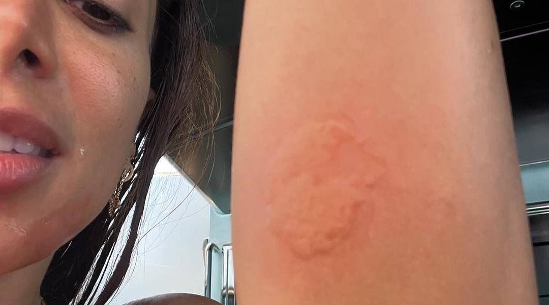 Anitta sufrió quemaduras en su cuerpo después del ataque de una medusa en Ibiza