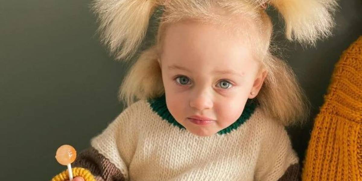 La niña con síndrome del pelo inquieto que inspira a amar la diferencia