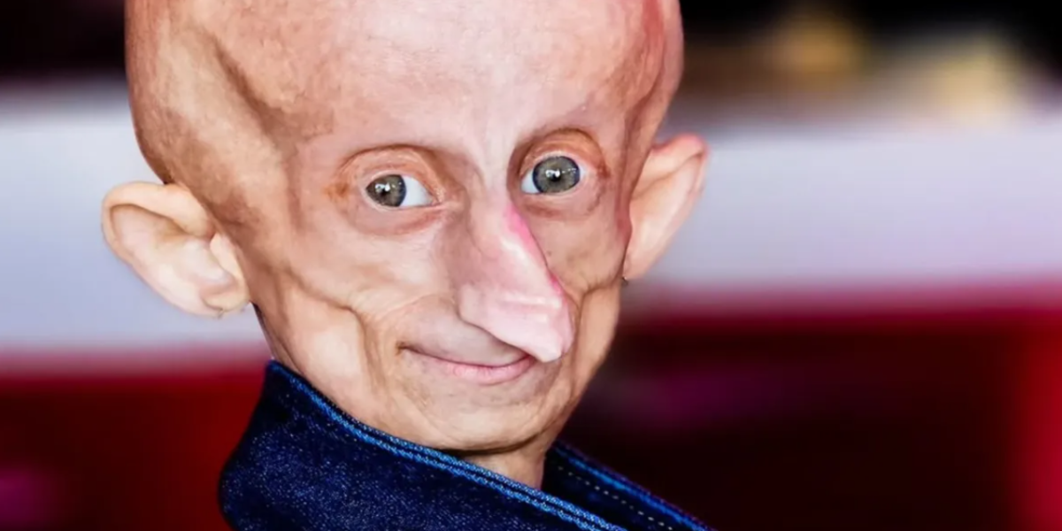 Fallece la influencer sudafricana Beandri Booysen, símbolo de lucha contra la progeria