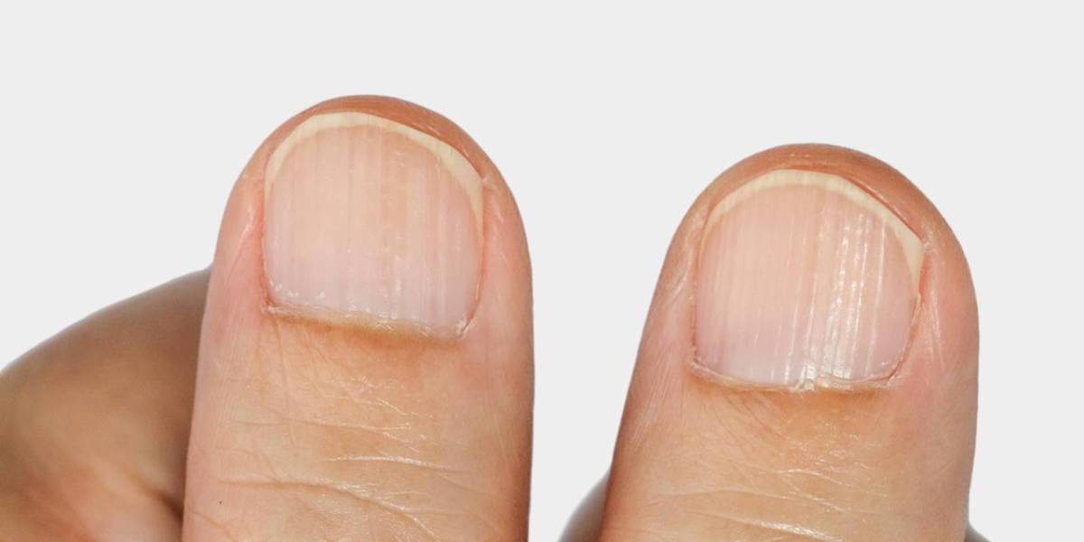 ¿Qué significa que tus uñas tengan rayas?