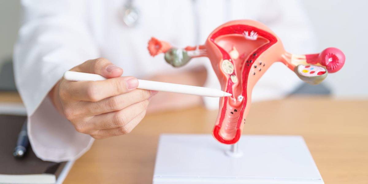 Cáncer de ovario: estos son los síntomas a tomar en cuenta para su detección temprana