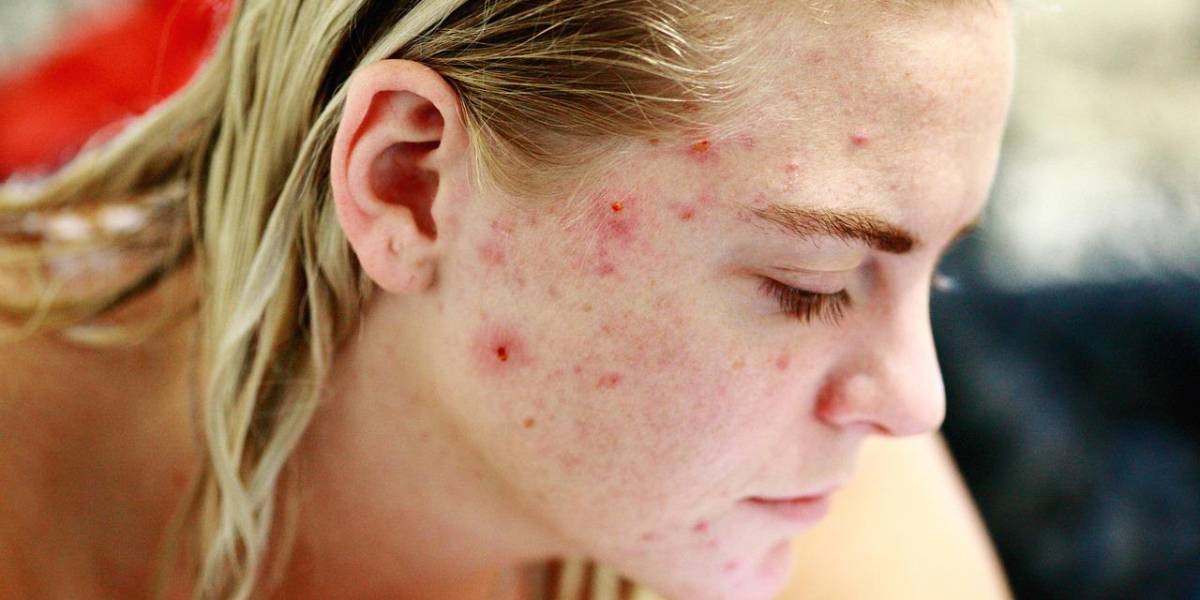 ¡Libérate del acné para siempre! Descubre los mejores remedios naturales para una piel impecable