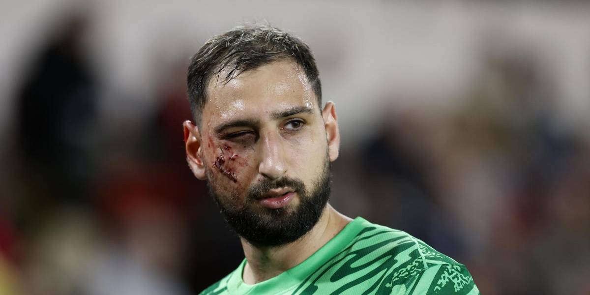 Así le quedó el rostro de Gianluigi Donnarumma, tras sufrir un duro golpe en la Liga Francesa