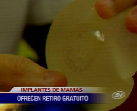 Cirujanos de Guayas ofrecen retirar implantes PIP