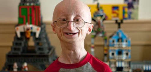 Progeria: el drama de morir de viejo a los 17 años