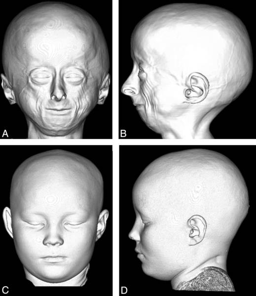 Anomalías craneofaciales en el síndrome de progeria (A y B) vs niño sin progeria (C y D).