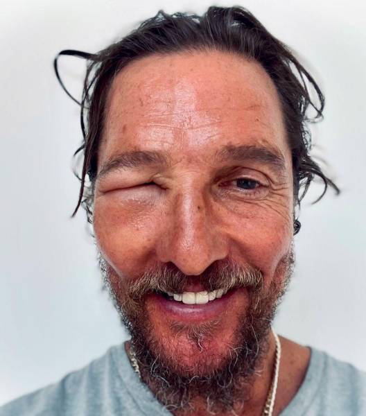 McConaughey hinchado tras ser picado por una abeja.