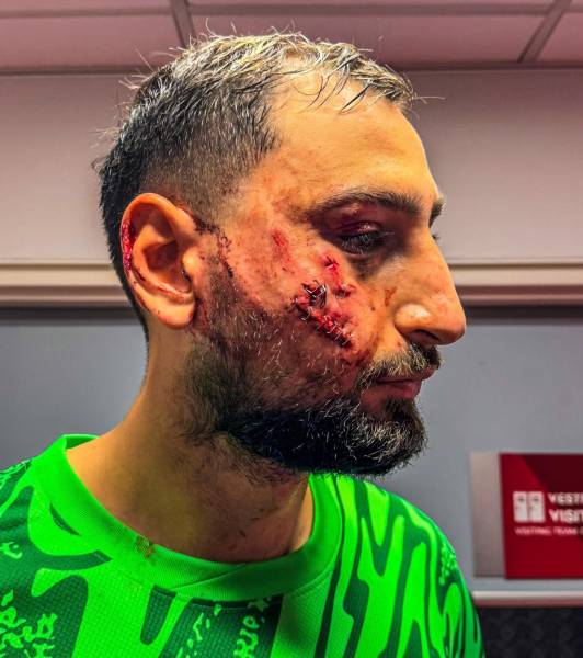 Así le quedó el rostro de Gianluigi Donnarumma, tras sufrir un duro golpe en la Liga Francesa