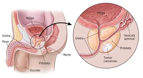 Imagen referencial de tumor canceroso en la próstata.