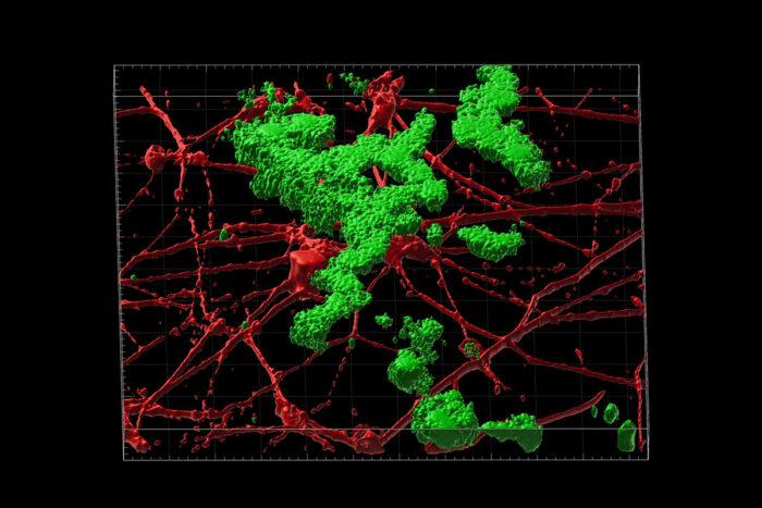 Innovadora técnica transforma células de la piel en neuronas para avanzar en el estudio del Alzheimer