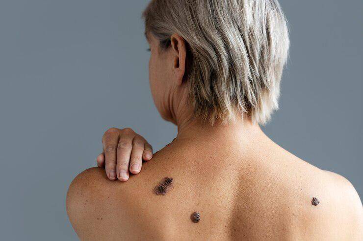 Protegiendo tu piel: importancia del monitoreo y prevención del melanoma