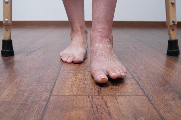 ¿Qué es la enfermedad del pie diabético y cómo prevenirla?