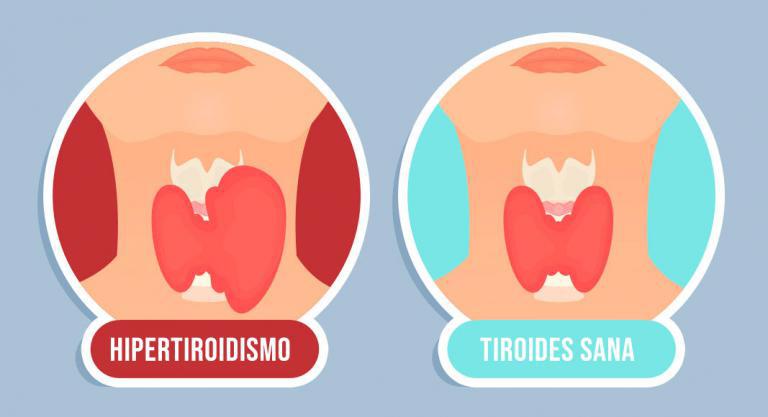 Imagen referencial de hipertiroidismo.