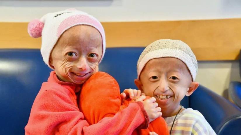 Dos niñas de 9 y 11 años que padecen progeria.