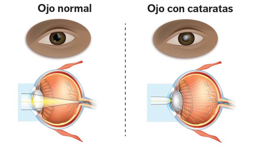 Así luce un ojo normal versus uno con cataratas