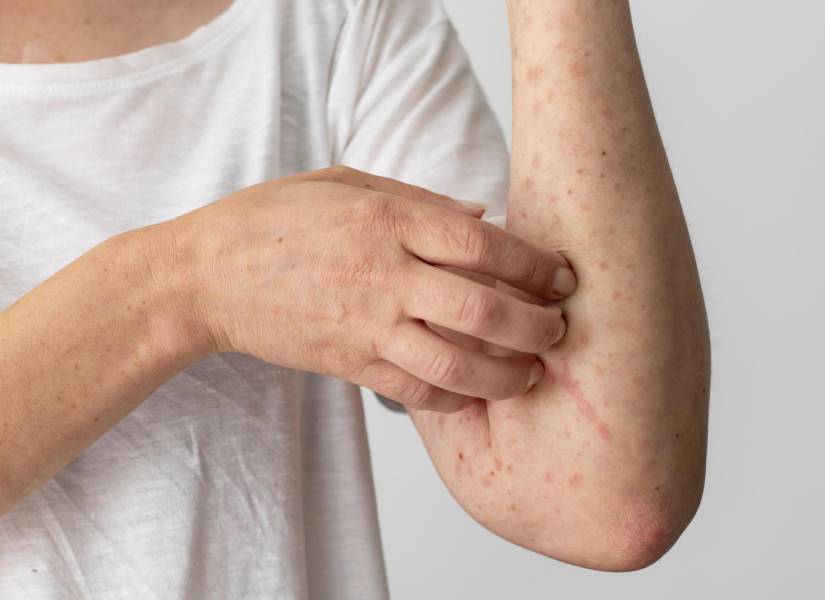 Reacción alérgica cutánea en el brazo de la persona.