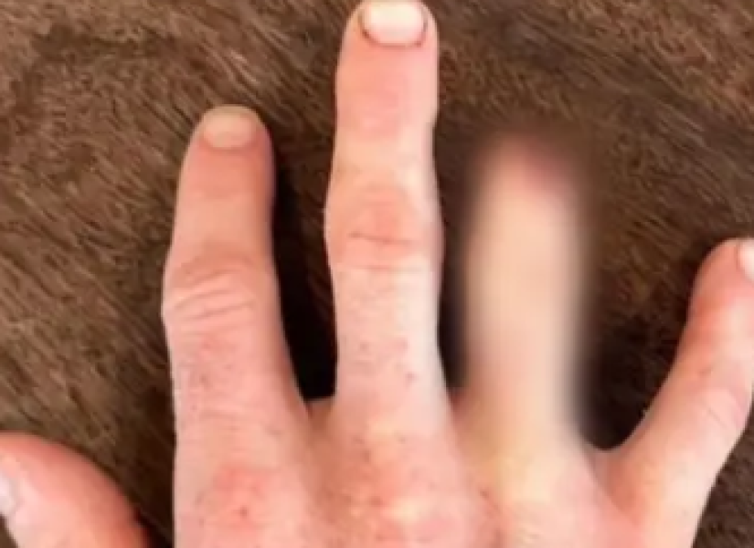 Mano derecha de Dawson con su dedo anular amputado parcialmente.